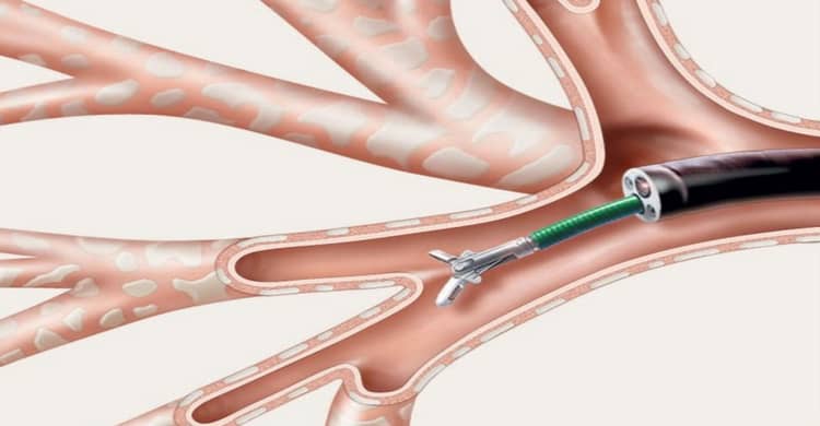 Cryobiopsy Cost in  Faridabad