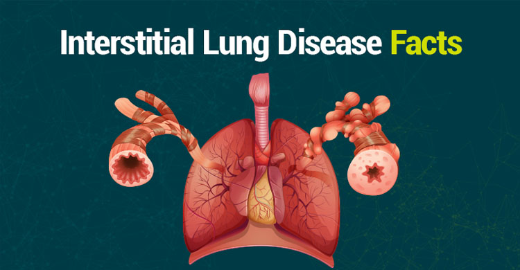 Interstitial Lung Disease Specialist in Faridabad