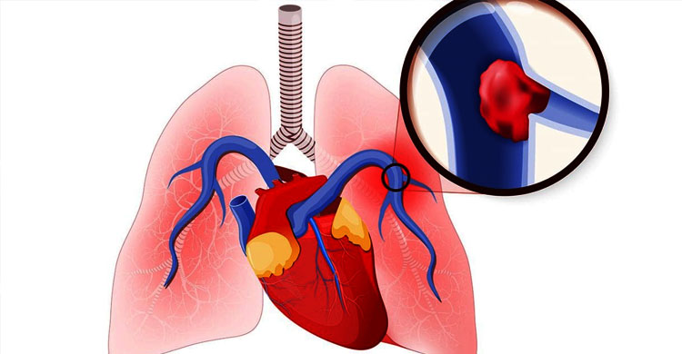 Chest Disease Treatment in Faridabad