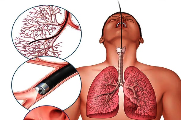 thoracoscopy treatment in faridabad